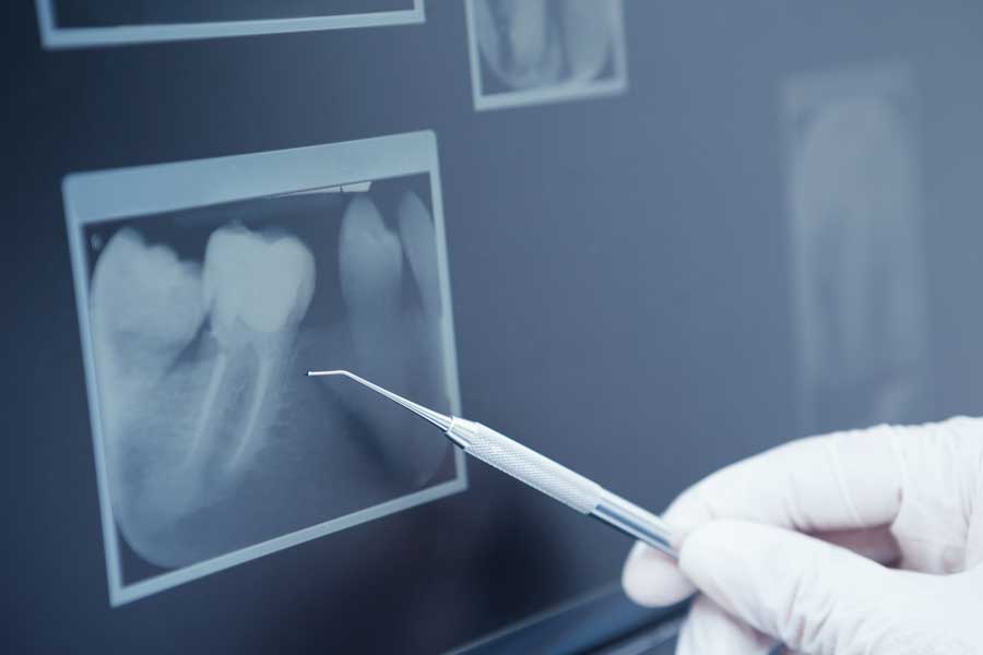 Devitalizzazione a Belluno e Treviso | Endodonzia | Dental Q