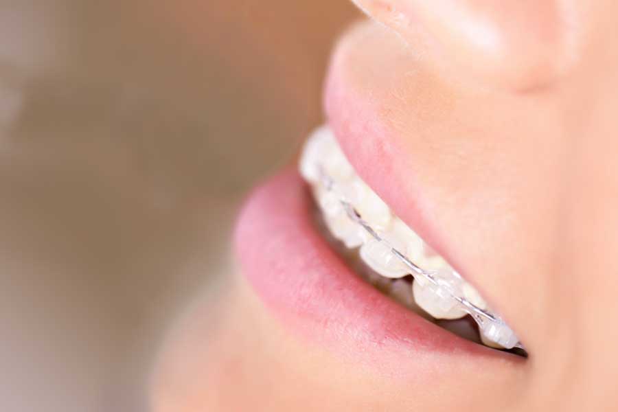 Ortodonzia | Apparecchio fisso a Belluno | Dental Q