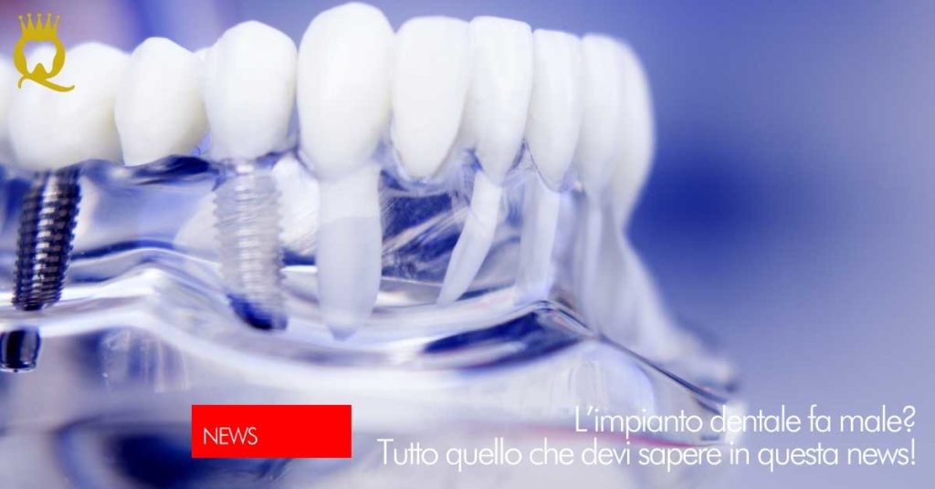 Impianto dentale fa male | Dental Q