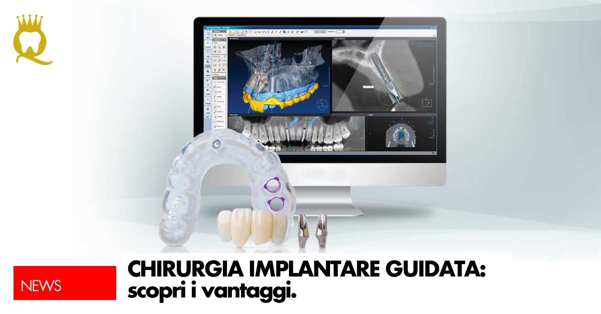 Impianto dentale | Dental Q | Dentista a Ponte delle Alpi