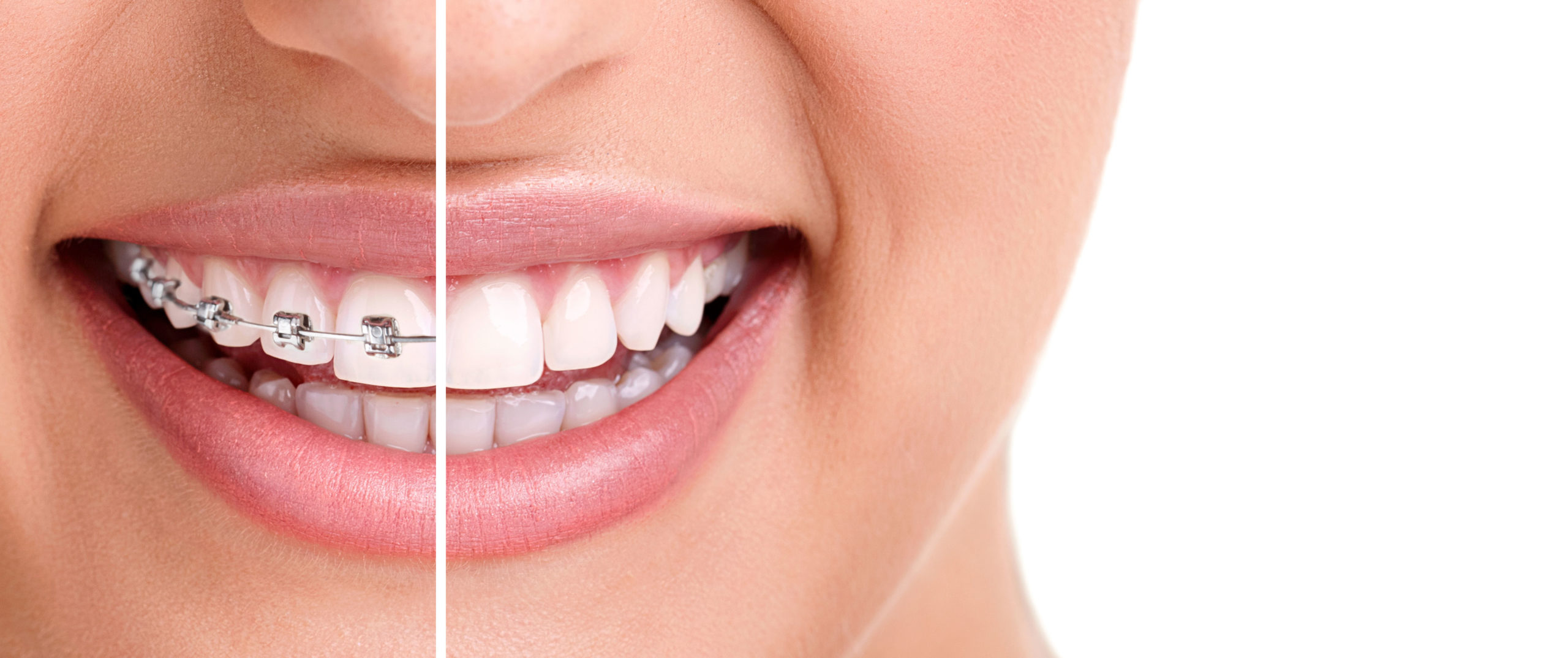 ortodonzia invisibile: sorriso con apparecchio