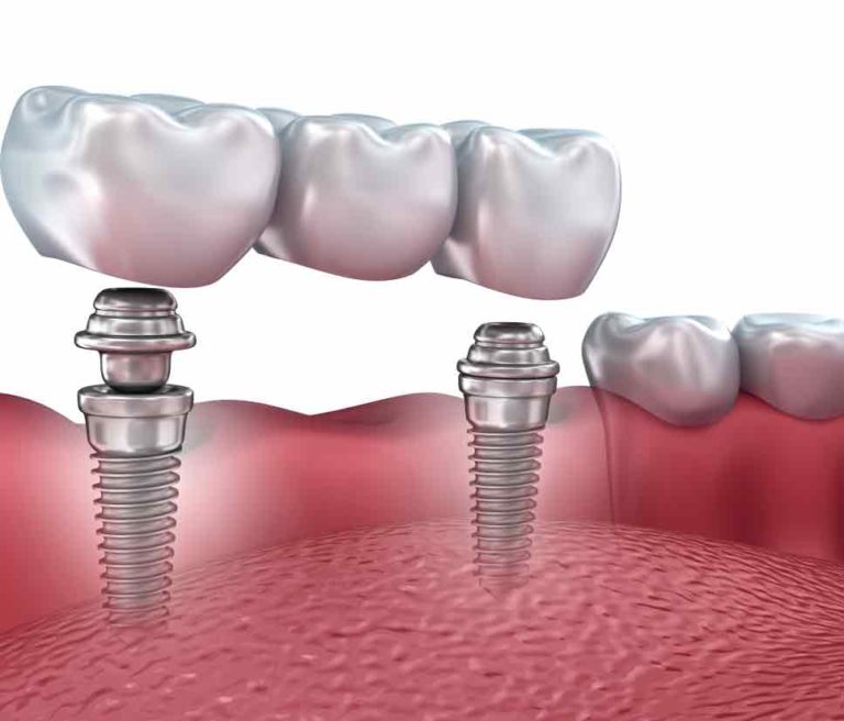 impianto dentale è doloroso: illustrazione impianto dentale